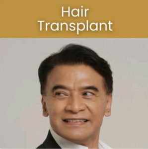 Sumber: https://farmaninaclinic.com/hair-restoration/hair-transplant/